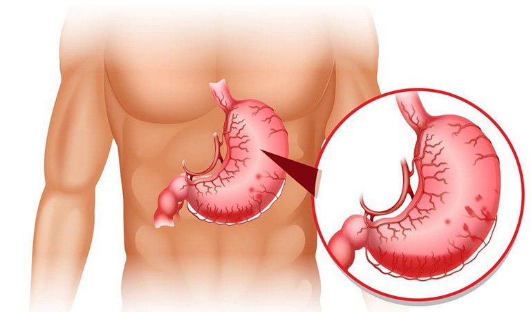 Sử dụng nước đá vôi để nấu ăn, uống sẽ gây nên các bệnh về dạ dày, ảnh hưởng tới hệ tiêu hóa  